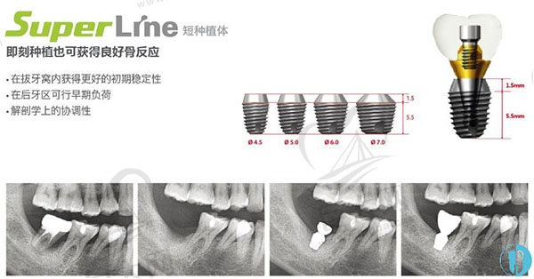 韩国登腾种植牙