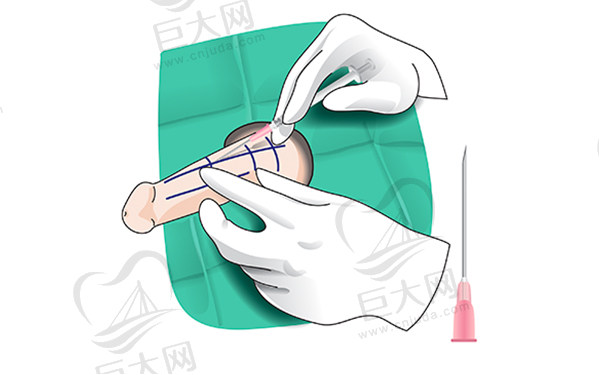 国内男性阴茎延长增粗专 家介绍