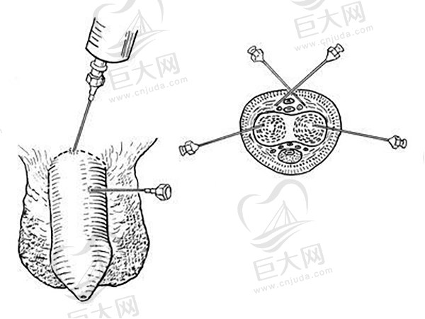 国内男性阴茎延长增粗专 家介绍