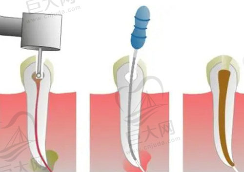 根尖诱导术治疗步骤