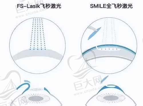 全飞秒手术后注意事项有哪些