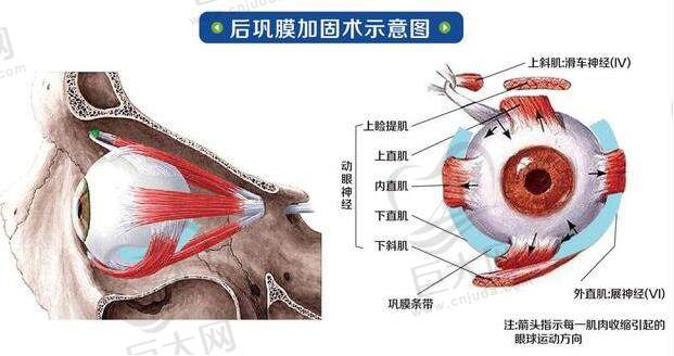 段安丽后巩膜加固术国内排名