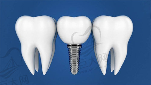 洛阳维乐口腔门诊种植牙价格