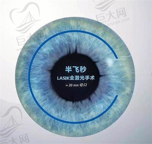 三亚明朗眼科医院半飞秒手术费用