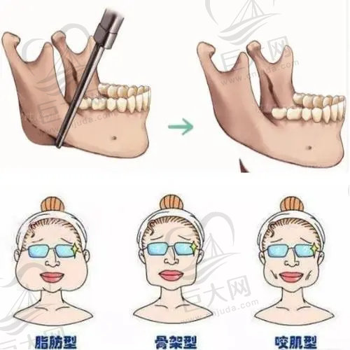 何照华医生做下颌角手术好吗