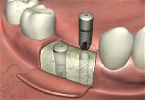中山香山口腔医院种植牙价格