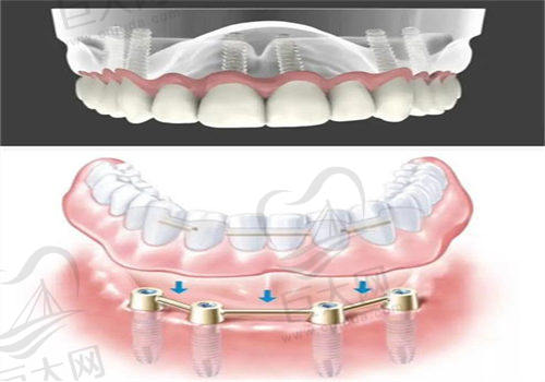 宁波佳兴口腔医院占瑛医生种植牙价格