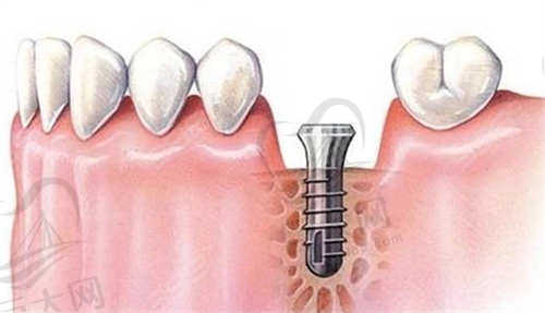 深圳凯伦口腔种植牙价格