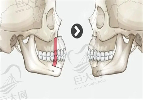 骨性凸嘴2.jpg