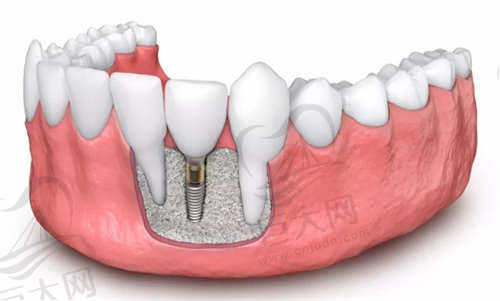 芜湖美臣口腔种植牙价格