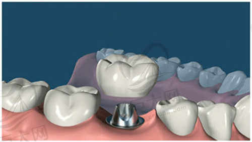舟山益雅口腔门诊部种植牙项目是什么