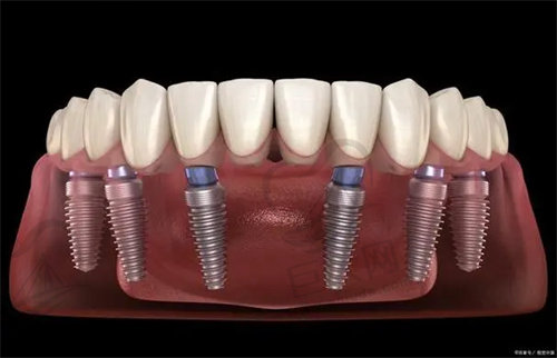 长沙美奥口腔医院种植牙怎么样