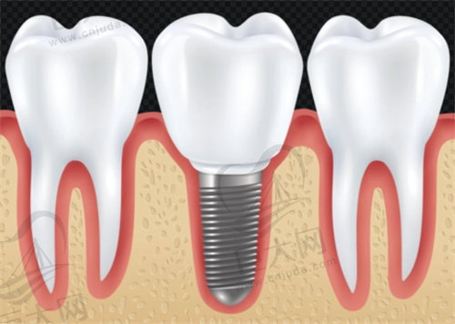 长沙美奥口腔医院种植牙多少钱