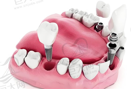 宁波牙博士口腔医院种植牙多少钱