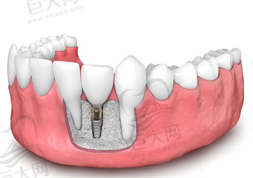 种植牙大概多少钱一颗