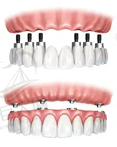 广州全口即刻负重种植牙医院排名广州全口即刻负重种植牙美尔好还便宜