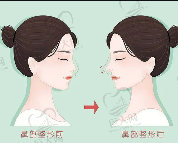 上海注射透明质酸隆鼻整形的费用是多少