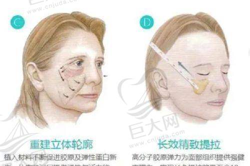 北京美莱医疗美容医院于双全乳头乳晕缩小的手术方案