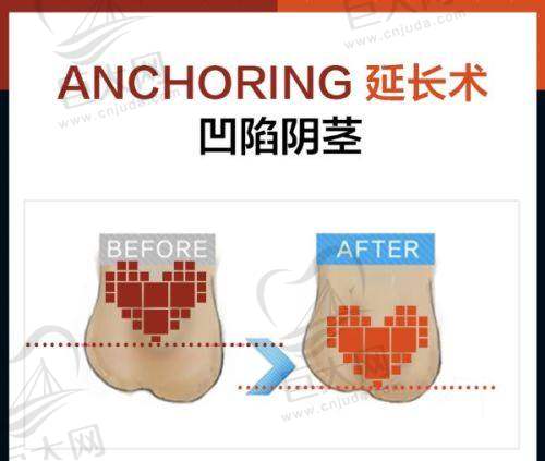 广州韩妃整形医院李光琴八维防生胸技术实例成效展示