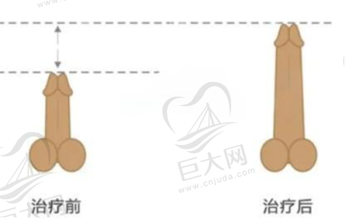 脂肪隆胸：30000元起的美丽之旅