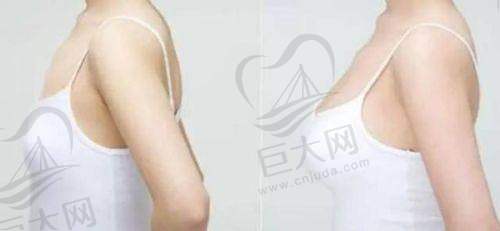 乳房下垂矫正：重拾挺拔胸部