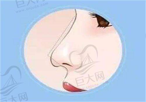 缩小鼻孔手术价格影响因素之其他方面