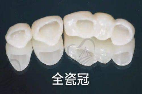 厦门同安种植牙价格表公示