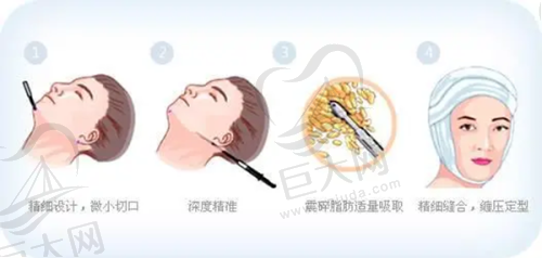 北京美莱医疗美容医院于双全乳房失败修复的成功经验