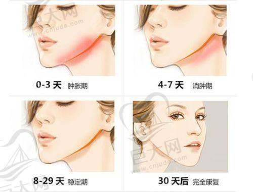 广东广州美莱医美医院蒙喜永腋下切口丰胸成效