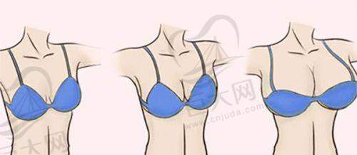 汕头华美隆鼻缩小鼻头价格