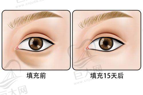 打唇珠过程中的注意事项