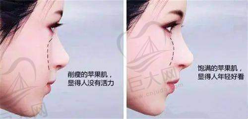 广州艺星医疗美容医院孙湄杨漫画胸设计方案有哪些