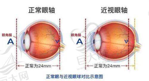 复明眼科医院的近视手术优势