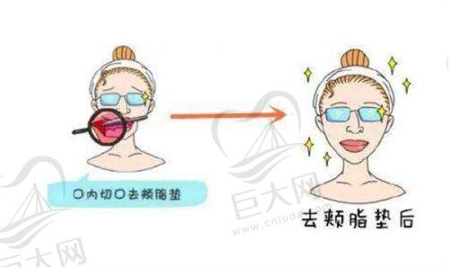 打唇珠前的注意事项