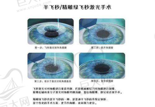 童星圆多点离焦镜片简介