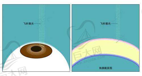 PRK手术成效