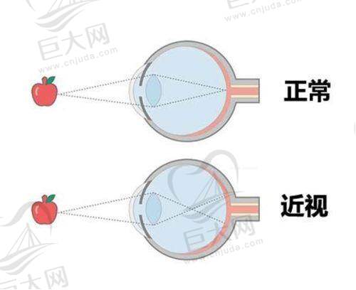 绍兴近视眼激光手术怎么选？绍兴爱尔眼科全激光手术价格多少，来这里直接看答案