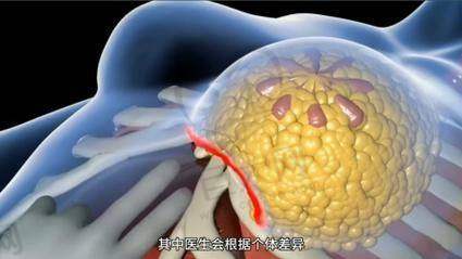 北京英煌美容医院项力源脂肪丰胸技术优势