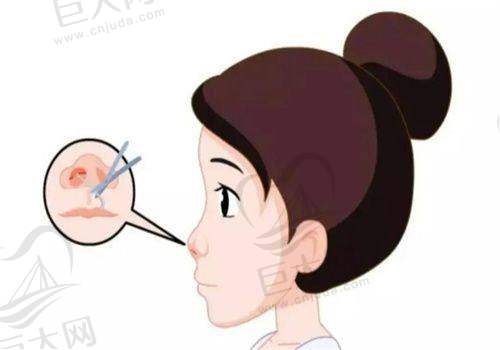 隆鼻项目优势