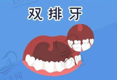 牙齿矫正项目费用及方案对比