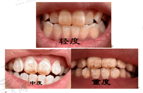 牙齿矫正价格表