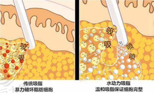 宁德脂溢性脱发植发相关