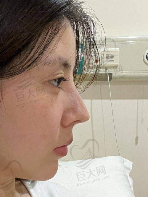 潍坊做鼻子性价比之选！潍坊医学院整形外科医院梁晓琴、苗春雷、杨彪炳隆鼻技术好，隆鼻手术2800元起