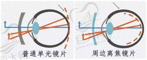 近视眼手术排名前三医院之杭州太学眼科