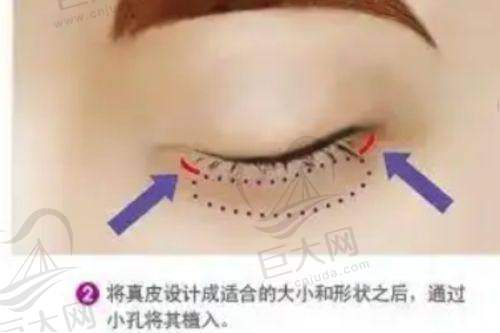 热门项目之隆鼻