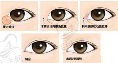 北京加减美曹正东面部轮廓疑难修复技术咋样？深层提拉与自然效果赢得患者高度认可