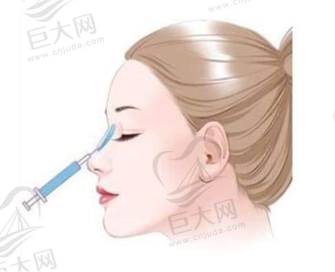 一文读懂艾莉薇玻尿酸有几种型号，各型号适用部位、价格及注射下巴对比全揭秘