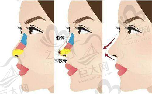山根低和塌鼻梁的区别图片大揭秘！从位置到特征，改良方法及注意事项全知晓