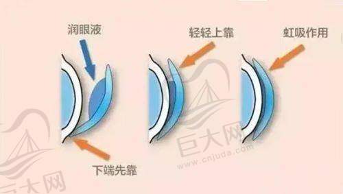 普瑞眼科就诊经历讲述