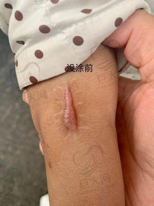 贵阳华医医院疤痕专科正规吗效果咋样？设备先进价格合理疗效好还有整形案例参考